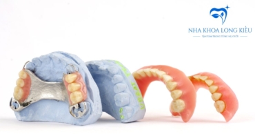 Trồng Răng Hàm Giả Tháo Lắp: Tổng Quan Về Các Loại Phục Hình Tháo Lắp
